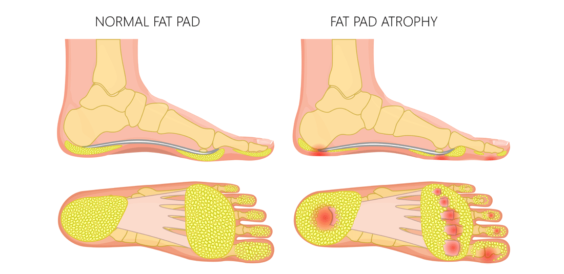 Heel Fat Pad Atrophy